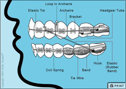 Parts of Your Braces